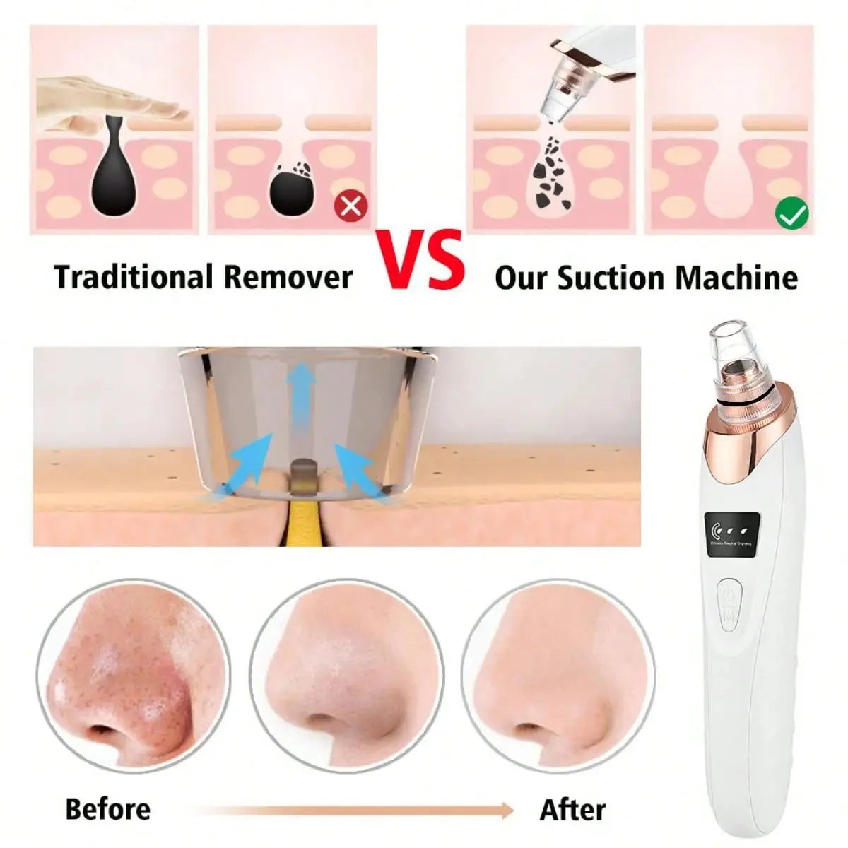 Portable Electric Blackhead Vacuum Remover Kit, Removes Blackheads & Whiteheads, Facial & Skin Care Device, 400mAh